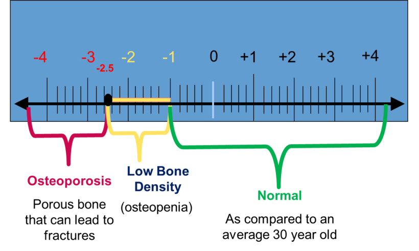 Bone Mass Scale Chart